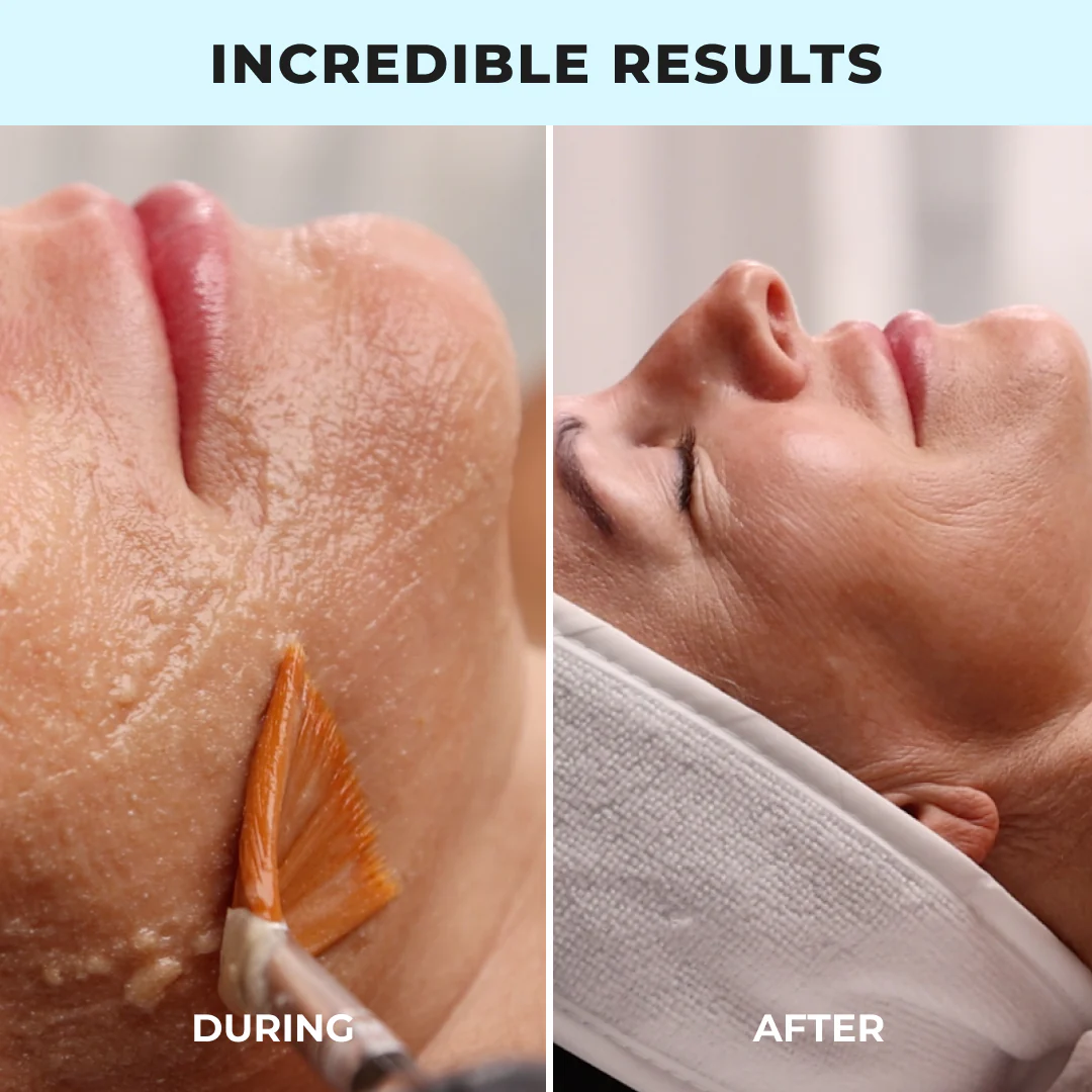 Luxe Lift Signature Facial Complete Bundle - Image 5